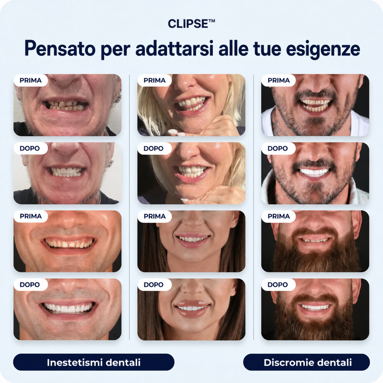 Faccette dentali Clipse®