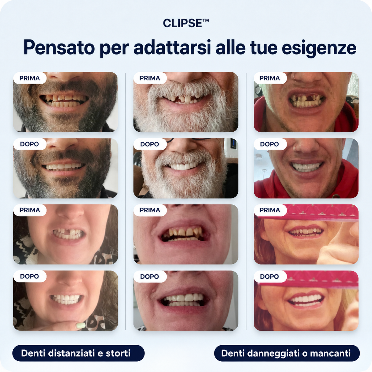 Faccette dentali Clipse®