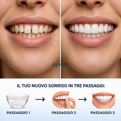 Faccette dentali Clipse®